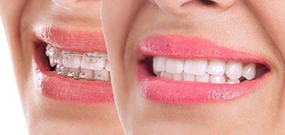 The image is a composite of two photographs, one on the left and one on the right. The left side shows a close-up of a person's face with a neutral expression. The right side features a smiling mouth with teeth visible against a blurred background.